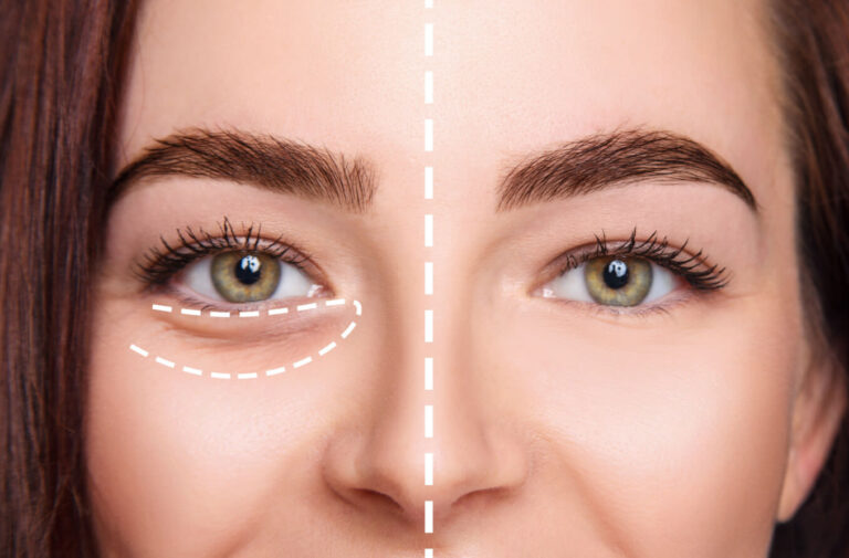 Understanding Tear Trough Filler: Benefits, Procedure, and Considerations